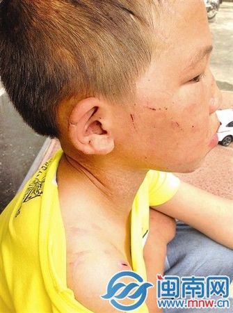 男孩的耳朵、脖子、臉上，有很多明顯的傷痕