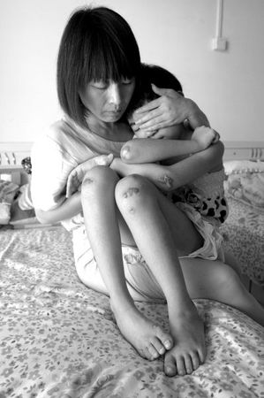 　女童的外傷基本痊愈，但留下了明顯的疤痕。京華時報記者蒲東峰攝