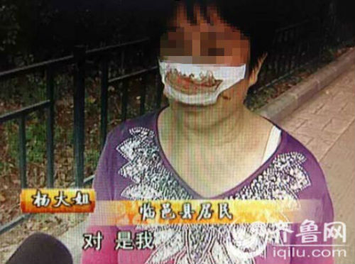 楊大姐自稱來自德州臨邑，鼻子是被丈夫一口咬掉的。（視頻截圖）