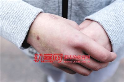　張燕每天都要隔絕打架的豪豬，白嫩的雙手如今全是傷口