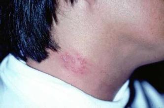 為什么年輕人也會得“帶狀皰疹”？