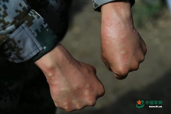 雖然戴著防蚊帽，穿著防護服，但巡邏回來，官兵的手上仍被蚊子叮起好多包。