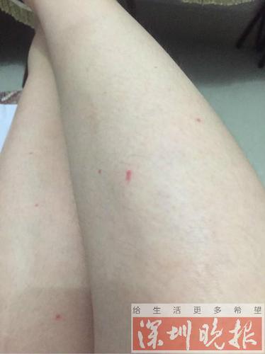 女子入住深圳一酒店 半夜醒來(lái)床上驚現(xiàn)十幾只臭蟲(chóng)