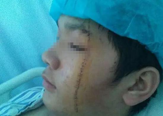 男生與同學(xué)產(chǎn)生口角被按地上刀割雙臉 老師不在場