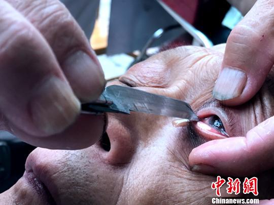 驚險又刺激的“刀鋒洗眼”?！螚?攝