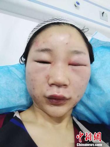 圖為當(dāng)事人提供的傷情圖?！【W(wǎng)絡(luò)圖攝