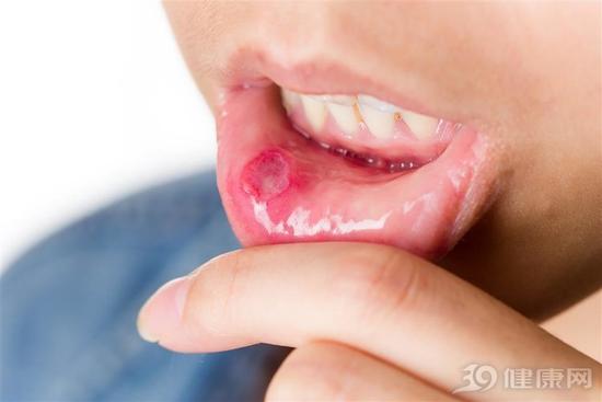 5個(gè)偏方 助你輕松“搞定”口腔潰瘍！
