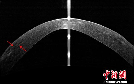 中國(guó)眼科專家創(chuàng)新再利用“廢”透鏡造福角膜病患者