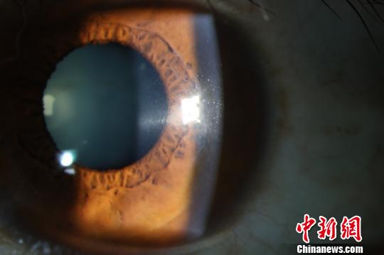術(shù)后2年，患者角膜透明。供圖